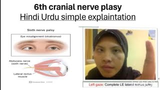 6th cranial nerve palsy in hindi urdu  simple explaintation  cranialnerves plasy [upl. by Ylyl773]