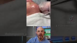 Dermatologist reacts to super satisfying clogged pore removal cloggedpores dermreacts [upl. by Einaled778]