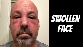 Swollen Face  Cancer Update [upl. by Nerro]