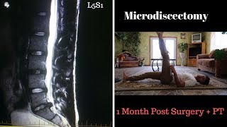 Microdiscectomy 1 Month Post Surgery L5S1 [upl. by Gnehs199]