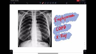 Chest xray of EmphysemaCOPD chestxray xraytutorial emphysema imaging radiology [upl. by Akerdal36]