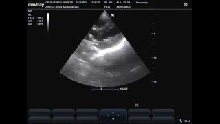 subcostal view of Kissing Heart in septic shock in patient with COPD [upl. by Roy]