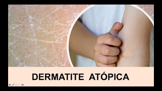 DERMATITE ATÓPICA  ECZEMA [upl. by Ravel]