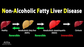 Nonalcoholic Fatty Liver Disease NAFLD Animation [upl. by Keraj]