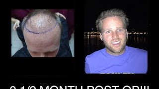 8 FUE Hair Transplant Mexico with Dr Nader in Reynosa 9 month post op [upl. by Hux]