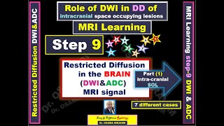 MRI learning Step9 Restricted diffusion DD in intracranial SOL 7 cases SEAL as mnemonic word [upl. by Emilie]