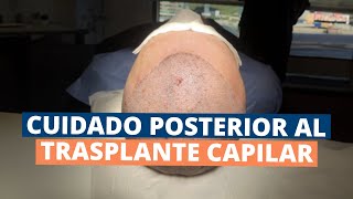 Cuidado posterior al trasplante de cabello [upl. by Svirad]