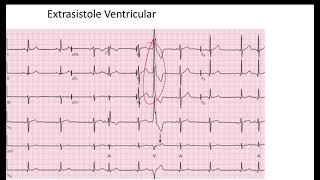 Comparación Extrasistole Auricular vs Ventricular EKG [upl. by Niak]