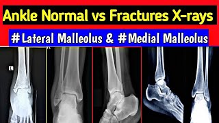 Ankle Fracture Xrays  Fracture Medial  Lateral  Posterior amp Both Malleolus  UdayXRay [upl. by Luhey]