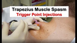 Soft Tissue Injection on Trapezius for Pain Relief [upl. by Limann]