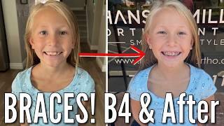 Shes Getting Braces  8 Year Old Goes to the Orthodontist to Get Braces Put On [upl. by Eimirej]