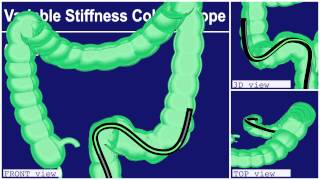 COLONOSCOPY Olympus Total [upl. by Lrig]