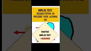 ROPLAS TEST dacryocystitis opthalmology [upl. by Nwahs97]