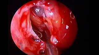 Right maxillary sinus empyema unedited uncinectomy middle meatal antrostomy under local [upl. by Gibb]