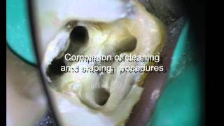 PeriodontalEndodontic considerations [upl. by Pampuch]