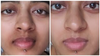 How I ACTUALLY got Rid of Pigmentation Around my Mouth  Pigmentation Treatment For Mouth Darkness [upl. by Onileba]