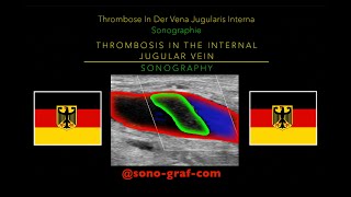 Sonographie  Thrombose In Der Vena Jugularis Interna [upl. by Cale457]