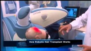 Robotic Hair Transplant Surgery  ARTAS Hair Restoration [upl. by Gretta]