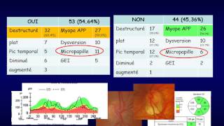 OCT et glaucome [upl. by Lachance]