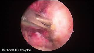 ACLR MEDIAL amp LATERAL MENISCUS ROOT REATTACHMENT REATTACHMEN OF ANTERIOR HORN OF MM  ALL AT ONCE [upl. by Eelirol]