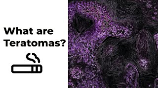 What are teratomas Explained Cancer Biology [upl. by Aoht]