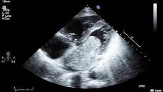 Large Atrial Myxoma [upl. by Geiss]