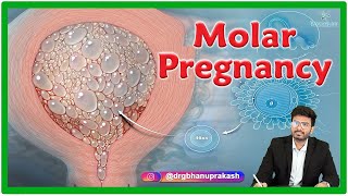 Molar Pregnancy  Causes Clinical manifestations Diagnosis and Treatment [upl. by Fabrienne]