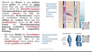 Varizen und Varikosis Teil 1 Ursachen Symptome Komplikationen Stadien nach Marshall [upl. by Cantone747]