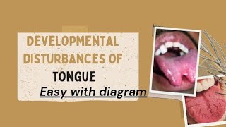 developmental disturbance of tongue part 2 follow for more dental dentalscience neetpg mds [upl. by Yrtnahc]