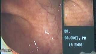 1 Minute Colonoscopy  Los Angeles Colonscopy [upl. by Simonsen54]