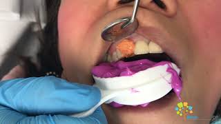 Cosmetic Dental Crown Procedure  All Ceramic Crown [upl. by Bahner]