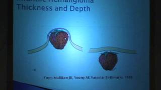 Laser Treatment for Hemangiomas Sorting Through the Myths [upl. by Nylessej]