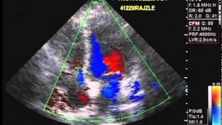 Echocardiography and Color Flow Doppler [upl. by Pestana427]