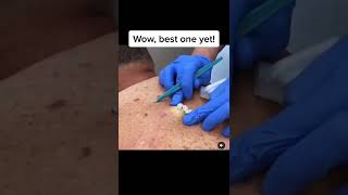 Blackheads Popping amp Blackhead Removal Videos 2022 [upl. by Ami]