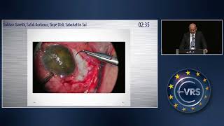 A Novel Surgical Method to Treat Hypotony [upl. by Cung]