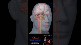 How Mechanical Thrombectomy Saves Stroke Patients Shorts [upl. by Oaoj]