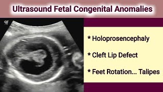 Ultrasound Fetal Holoprosencephaly [upl. by Trevethick917]