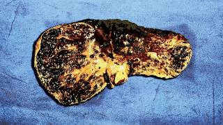 A Family Ate 1 Year Old Frozen Leftovers For Breakfast This Is What Happened To Their Organs [upl. by Sudnor]