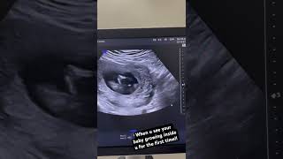 14 weeks baby growing inside the womb baby gynaecologist ultrasound pregnancyultrasound [upl. by Reena]