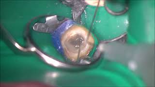 Complete removal of contaminated guttapercha from the Cshaped root canal using ultrasonic device [upl. by Raamal]