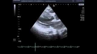 HCM with rupture of mitral chordae tendineae [upl. by Ingrid]