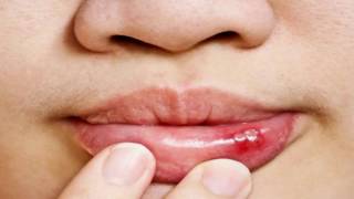 Difference Between Cold Sore and Canker Sore [upl. by Desberg]