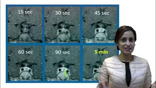 Prolactinoma DAMS Medicine Unplugged Integrated Microadinoma [upl. by Curr]