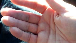 Finger twitching from Lyme Disease [upl. by Otis]