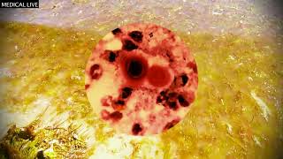 Cryptococcus gattii infection [upl. by Annek]