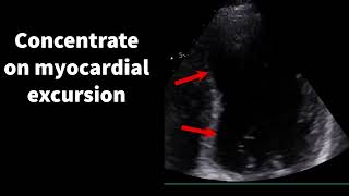 Reverse Takotsubo cardiomyopathy [upl. by Rebmak]