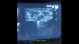 Sciatic nerve block at popliteal fossa for heel surgery by Dr Sairah Sadaf [upl. by Henryk]