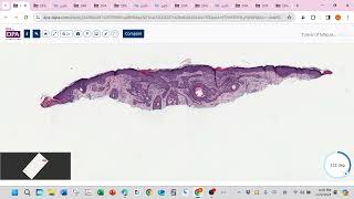 Tumor of follicular infundibulum [upl. by Nalyk]