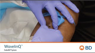 BD WavelinQ™ EndoAVF Cannulation Quick Training with patient [upl. by Adnaluoy]