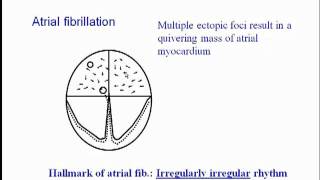 ECG Atrial Fibrillation [upl. by Jadd]